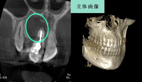 根っこの先にできた 膿の袋の大きさや 位置関係まで確認できます 歯の痛みの原因はこれですね なかなか大変ですが頑張っていきましょう データをつなぎ合わせ 歯の立体画像を 作り出すこともできます